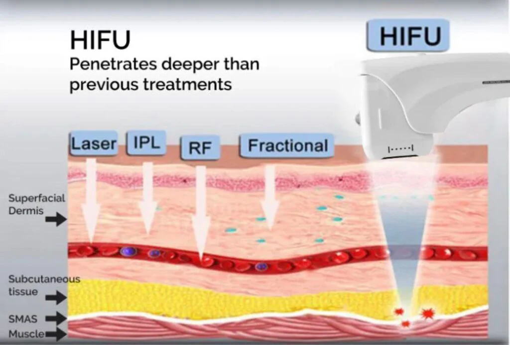 تفاوت هایفو 7 بعدی با هایفو 3 بعدی