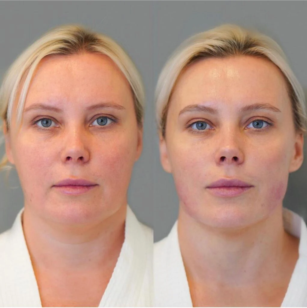 قبل بعد دستگاه هایفو 7 بعدی