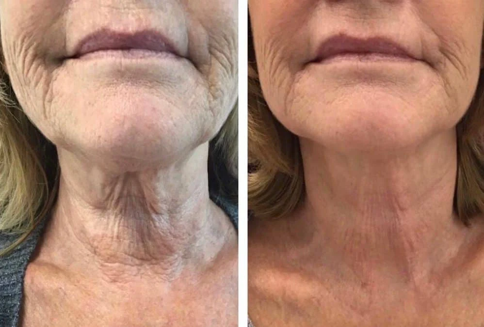 قبل و بعد دستگاه هایفو